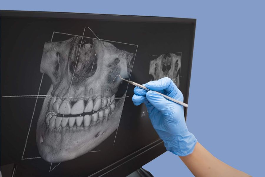 Hand in einem blauen Handschuh zeigt mit einem zahnmedizinischen Gerät auf ein 3D-Röntgenbild