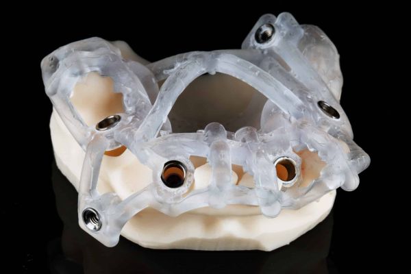 Schablone auf einem Gebissmodell für die geführte 3D-Implantation